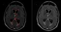 Volumetry of cerebrospinal fluid on Flair